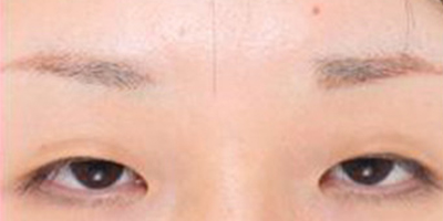 假體墊眉弓術前