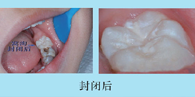 兒童口腔預防窩溝封閉術后