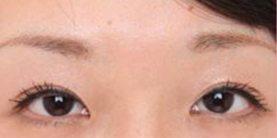 假體墊眉弓術后