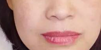 經絡凈排術后