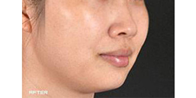 皮秒激光術后