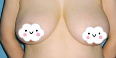 女性乳房縮小術前