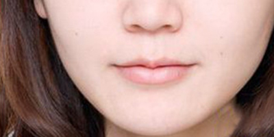 嘴角上揚(yáng)術(shù)術(shù)后
