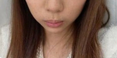 黃金煥膚術前