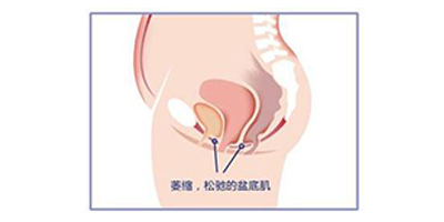 盆底肌修復術前