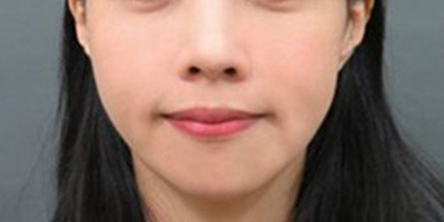 童顏針術后