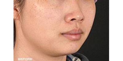 皮秒激光術前