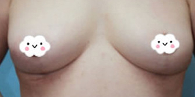 女性乳房縮小術后