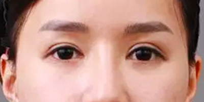 自體脂肪豐臥蠶術前