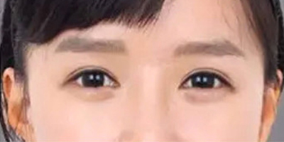 自體脂肪豐臥蠶術后