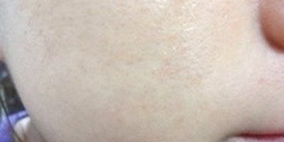果酸煥膚術后