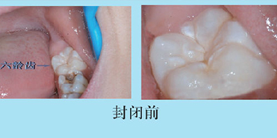 兒童口腔預防窩溝封閉術前