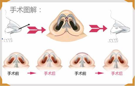 縮鼻頭手術(shù)可以保持多久？縮鼻頭手術(shù)術(shù)后注意事項？