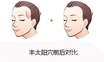 什么是自體脂肪豐太陽穴？用自體脂肪豐太陽穴的效果能維持多久？