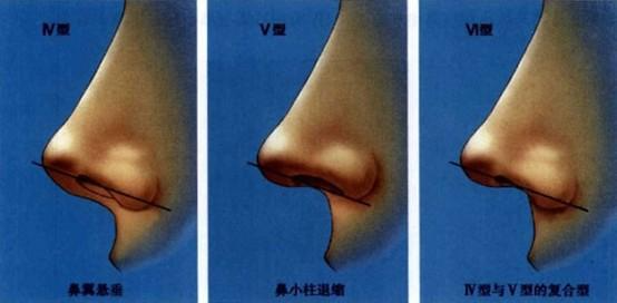 鼻小柱延長術(shù)一般價位多少錢？做鼻小柱延長術(shù)有什么不好的影響嗎？