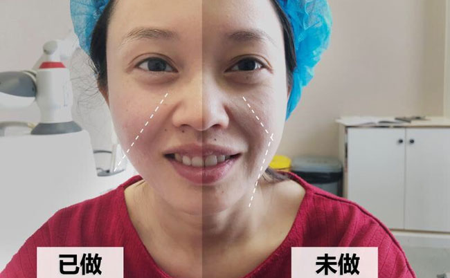 激光溶脂瘦臉的副作用及效果？光纖溶脂瘦臉多久可以見效？