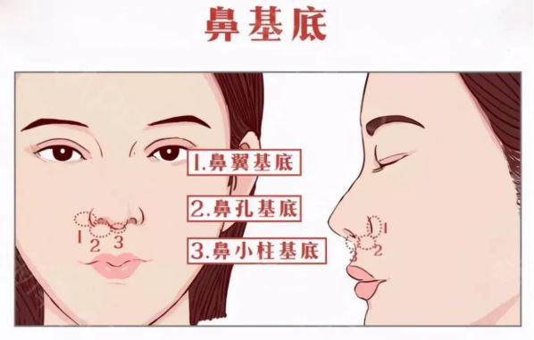 自體脂肪填充鼻基底好不好？鼻基底脂肪填充多久恢復？