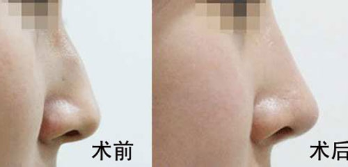 駝峰鼻矯正的方法有哪些？駝峰鼻矯正的方式及適合人群？