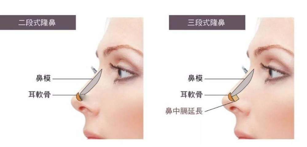 自體軟骨隆鼻的手術(shù)優(yōu)缺點(diǎn)有哪些？肋軟骨填充鼻基底多久能自然？