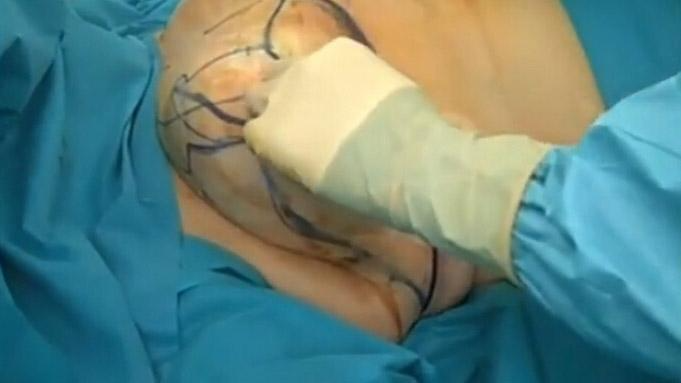 乳房縮小手術(shù)要多少錢？乳房縮小術(shù)是大手術(shù)嗎？