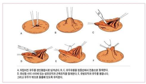 乳頭內(nèi)陷矯正手術(shù)多少錢？乳頭內(nèi)陷矯正手術(shù)多久可以恢復(fù)？