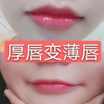 厚唇改薄整形手術(shù)價格?厚唇改薄多久完全恢復(fù)? 厚唇改薄整形手術(shù)價格?厚唇改薄多久完全恢復(fù)?