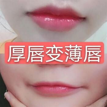 厚唇改薄整形手術(shù)價(jià)格？厚唇改薄多久完全恢復(fù)？