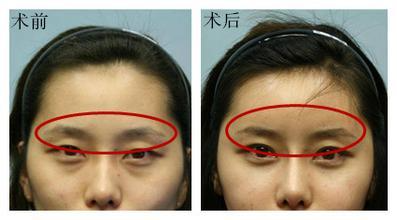 自體脂肪填充眉弓安全嗎？自體脂肪填充是永久的嗎？