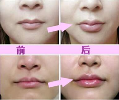 玻尿酸豐唇珠效果怎么樣？玻尿酸豐唇珠多少錢？