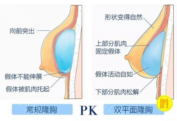 假體隆胸修復(fù)怎么做？做隆胸修復(fù)能維持多久？
