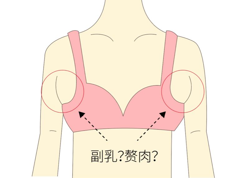 手術(shù)去副乳效果怎么樣？手術(shù)去副乳要注意什么？