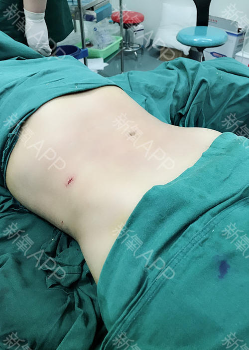腰腹抽脂效果怎么樣？腰腹抽脂沒有瘦的原因？