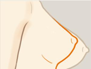 乳房下垂矯正手術(shù)風(fēng)險(xiǎn)有多大？ 乳房下垂矯正術(shù)多久能恢復(fù)？