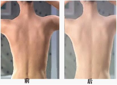 背部吸脂多久恢復(fù)？吸脂瘦背部注意事項(xiàng)