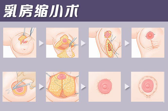 女性乳房縮小多少錢 ？女性乳房縮小住院幾天？