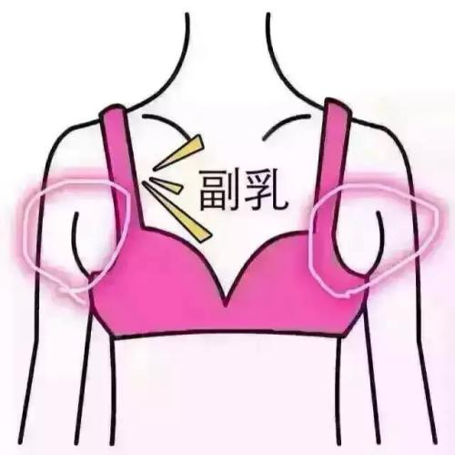 吸脂做副乳要多少錢？吸脂去副乳會反彈嗎？