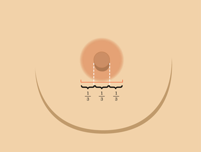 乳暈縮小如何矯正 乳暈縮小術(shù)的注意事項有哪些？