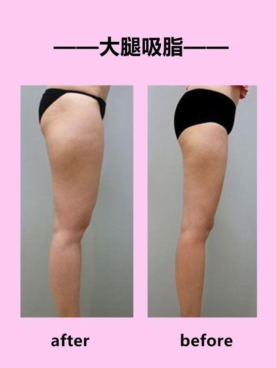 吸脂瘦雙腿有效嗎 吸脂瘦小腿效果的方法