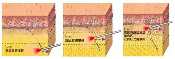 優(yōu)立塑的原理是什么 優(yōu)立塑禁忌人群