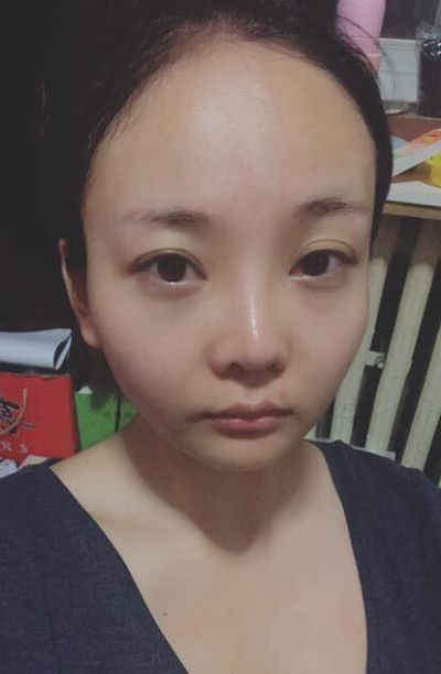 煙臺(tái)韓美美容整形外科診所金東浩熱瑪吉案例效果分享