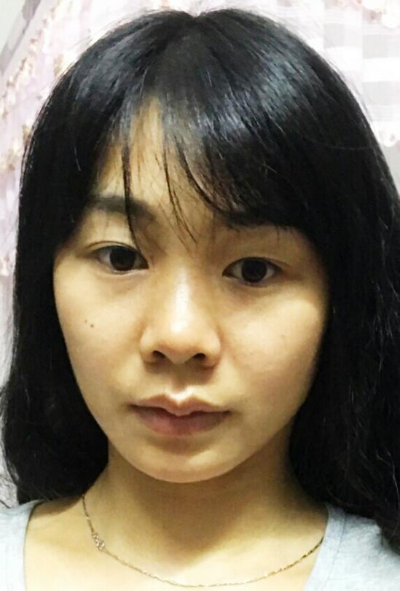  廈門(mén)華美名媛整形美容醫(yī)院俞積貴雙眼皮案例效果分享