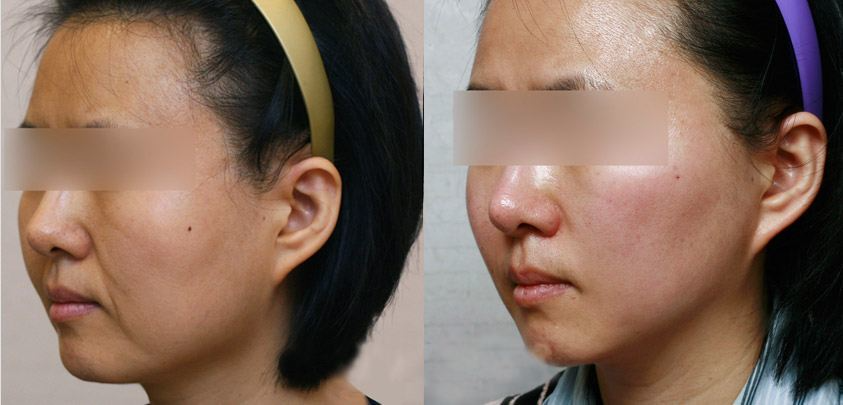 熱瑪吉做一次可以保持多久？熱瑪吉的原理和功效