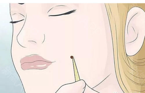 激光點痣要多久才會恢復？激光點痣多少錢？