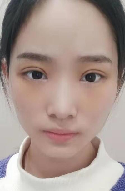 長(zhǎng)沙星雅醫(yī)療美容醫(yī)院萬友望雙眼皮案例效果分享