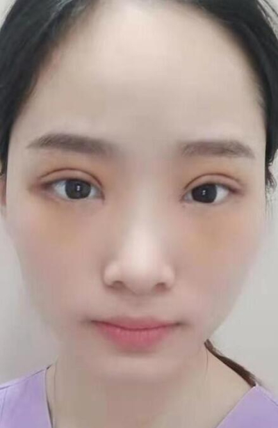  長沙星雅醫(yī)療美容醫(yī)院做雙眼皮手術(shù)后的大眼