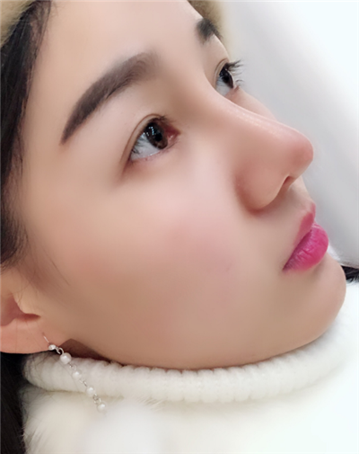 長(zhǎng)春中妍醫(yī)療美容醫(yī)院隆鼻手術(shù)后鼻子情況基本穩(wěn)定