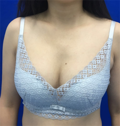 煙臺壹美整形美容醫(yī)院做隆胸手術(shù)后半個(gè)月的情形