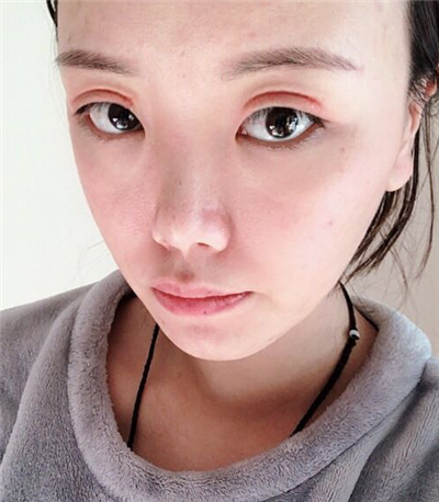 珠海韓妃醫(yī)療美容門診部李友良雙眼皮案例效果分享