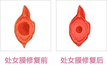 成都東方整形處女膜修復(fù)怎么樣？處女膜修復(fù)術(shù)后如何護(hù)理？