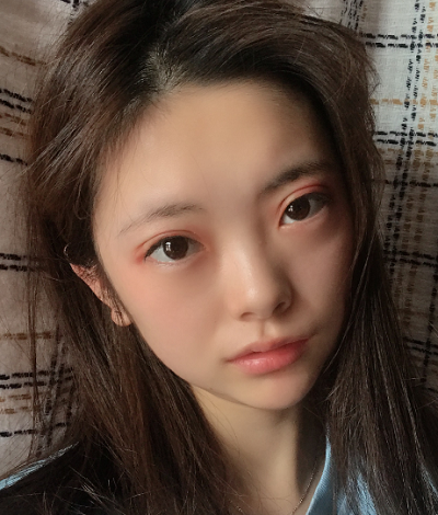 安徽韓美整形美容醫(yī)院做雙眼皮手術(shù)的第七天